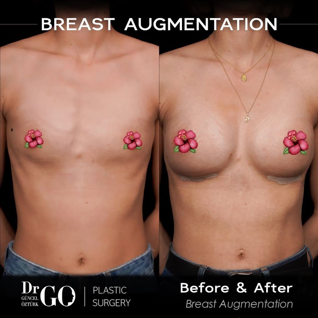 Assoc. Prof. Dr. Güncel Öztürk — Breast Augmentation before and after