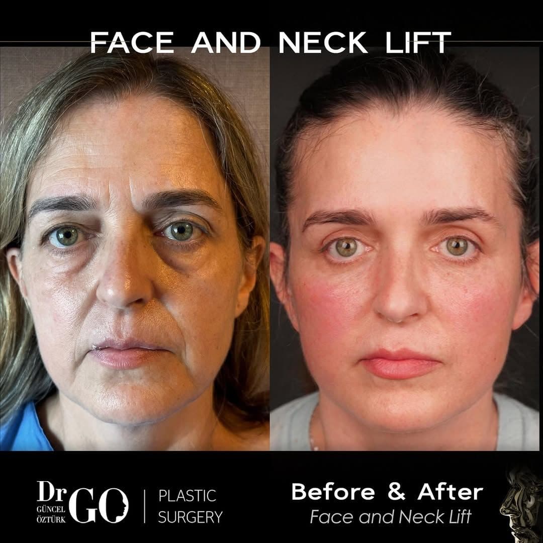 Assoc. Prof. Dr. Güncel Öztürk — Facelift & Neck Lift before and after