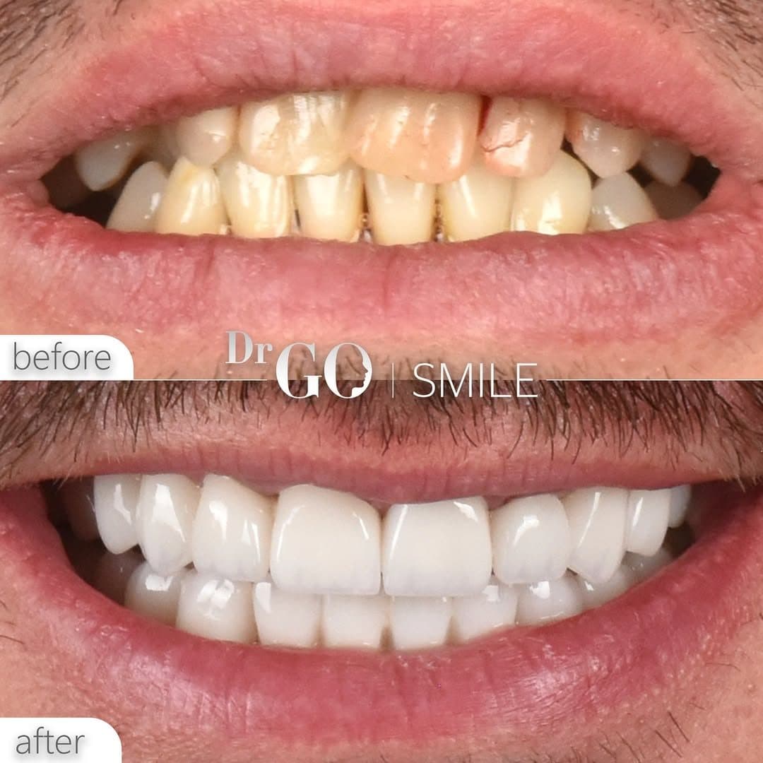 DRGO Smile — Smile makeover before and after