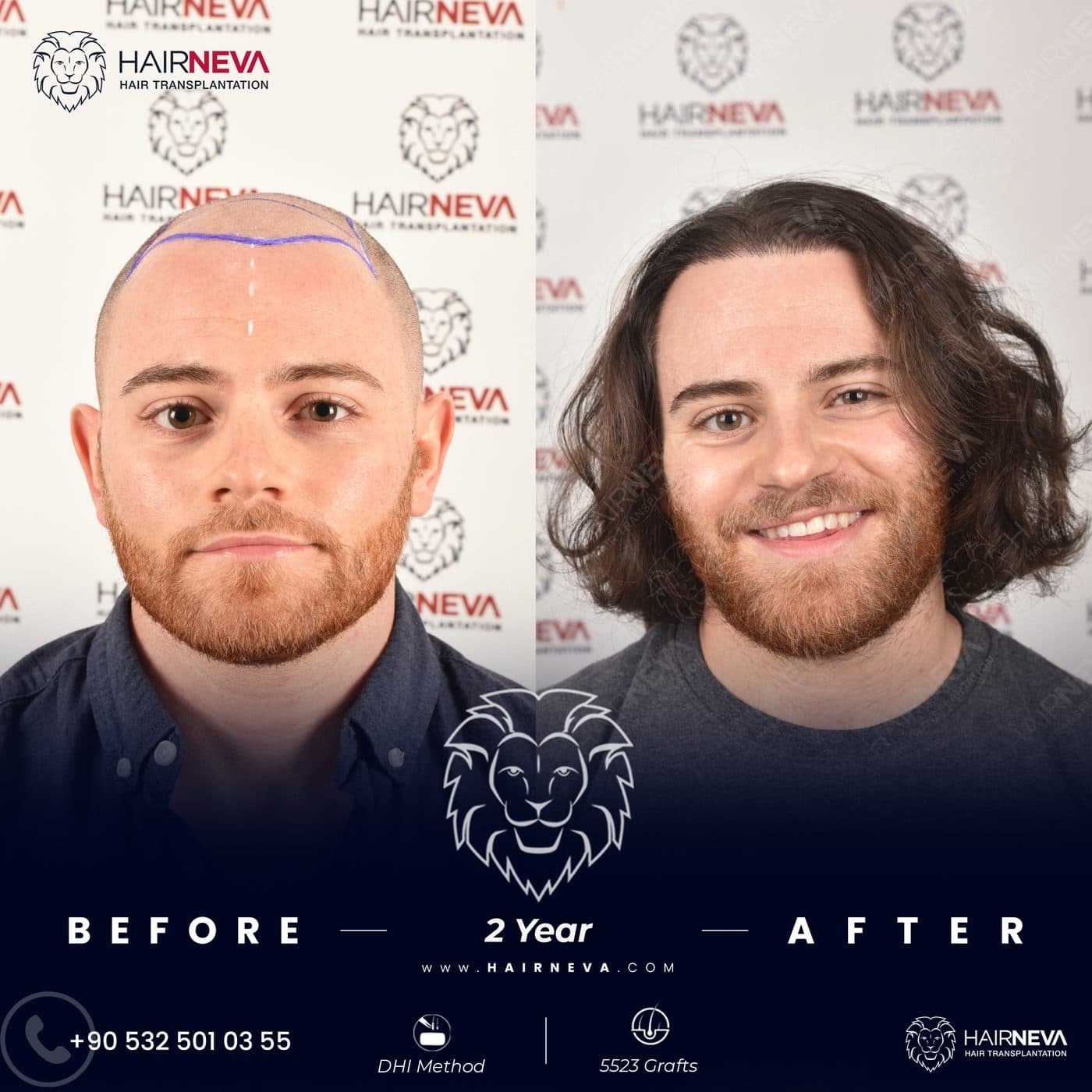 HairNeva — Hair transplant before and after