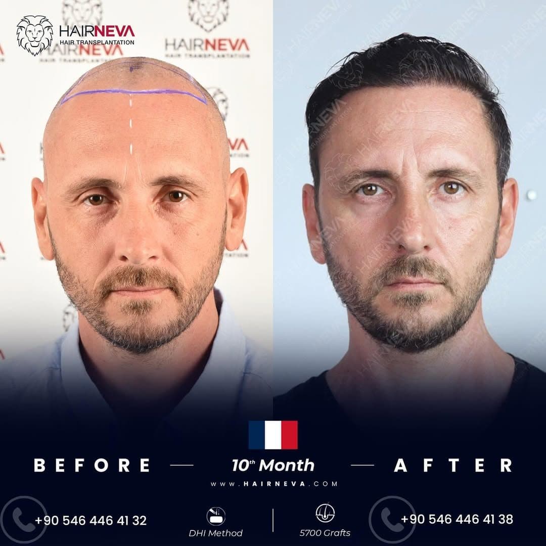 HairNeva — Hair transplant before and after